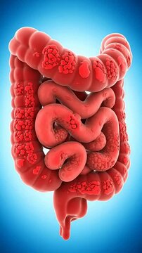 Realistic 3D Illustration Of Human Intestines Depicting Crohn's Disease For Medical Education And Healthcare Technology