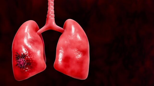 Malignant Lung Tumor with Expanding Cancer Root Network Tissue Remodeling Cell Proliferation and Progressive Pulmonary Disease 3D Rendering
