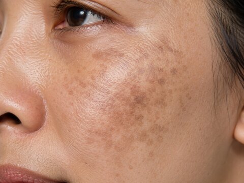 Close up of face with uneven skin tone and dark spots on cheek of adult woman with natural light
