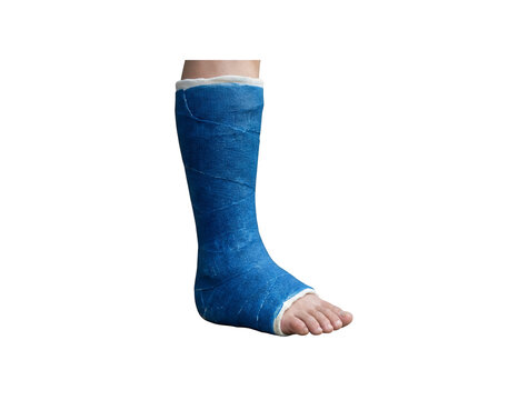 Blue fiberglass leg cast on human foot, medical orthopedic plaster for broken bone recovery, surgical rehabilitation for ankle fracture and injury isolated on Transparent Background