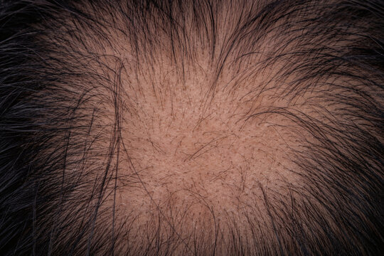 Severe Crown Hair Thinning and Scalp Visibility in Androgenetic Alopecia Close Up