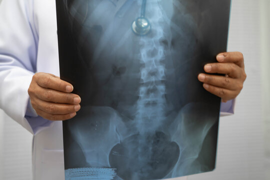 Doctor examining spine bone radiography xray film.