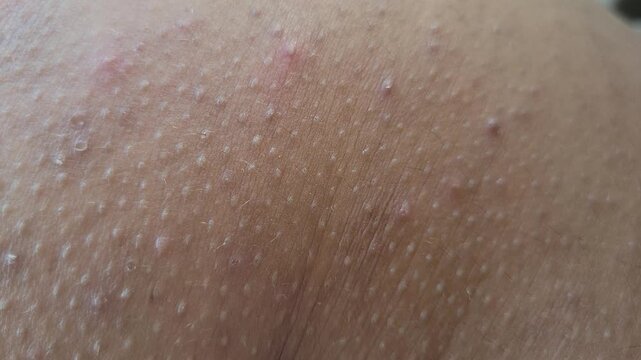 Macro close-up of human skin with goosebumps and tiny bumps
