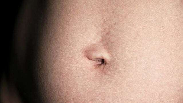 Navel close-up front view. A woman's stomach after pregnancy with stretch marks on the skin. A scar after laparoscopic surgery through the navel. Body part. Postoperative lymphatic edema on a abdomen.