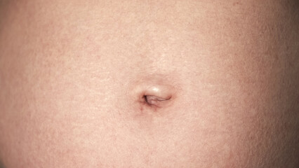 Fototapeta premium Navel close-up front view. A woman's stomach after pregnancy with stretch marks on the skin. A scar after laparoscopic surgery through the navel. Body part. Postoperative lymphatic edema on a abdomen.