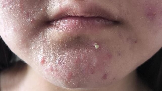 a pimple on the chin of a young woman. Problem skin, acne, dermatological diseases