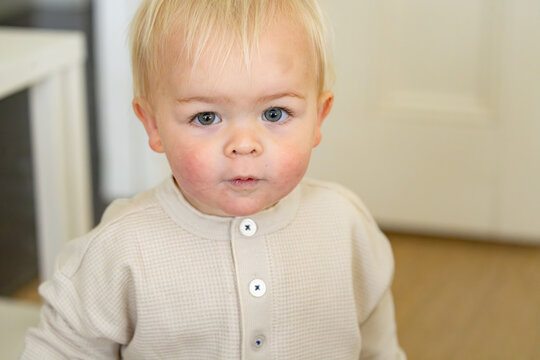 Toddler boy holding staring with a bruise on his forehead