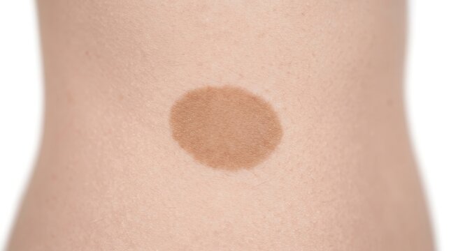 Close up of a large cafe au lait spot or birthmark on human skin