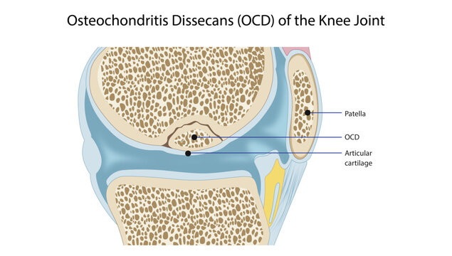 Osteochondritis Dissecans (OCD) of the Knee Joint, depicting osteochondritis dissecans (OCD) of the knee, showing a focal osteochondral lesion beneath the articular cartilage.