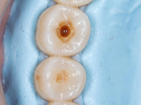 Close up of human teeth with decay and blue dental dam cavity tooth