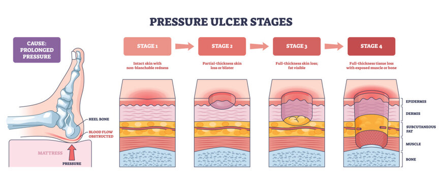 Pressure ulcer stages infographic illustrating progressive skin breakdown from prolonged pressure, shows heel, skin layers, and mattress pressure point. Outline diagram