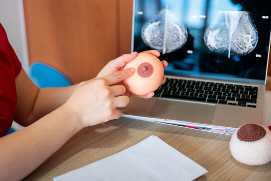 Midwife explaining mammogram results with anatomical model