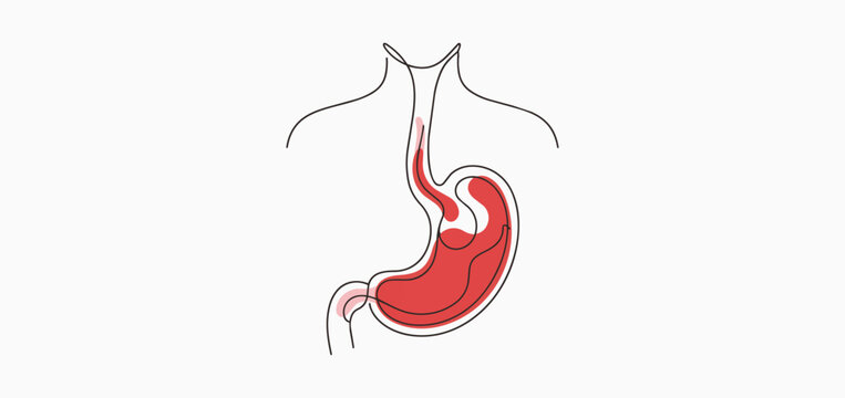 Acid reflux disease medical illustration showing the stomach and esophagus with heartburn