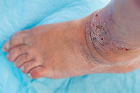dermatitis allergic reactions, itchy skin on leg, closeup injured female limb damaged reddened skin scratches, wound on painful female leg, chronic dermatological disorder, skin problem, affected area