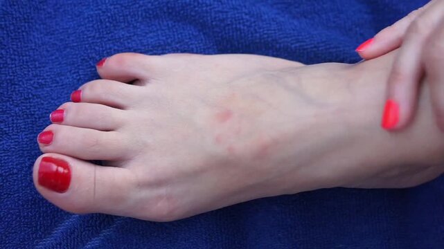 Close-up of a woman checking and touching a red skin rash or allergic reaction on her foot while resting on a blue beach towel.