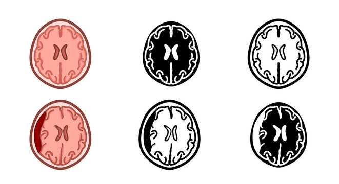 Brain Hemorrhage Anatomy Icons Set &ndash; Normal Brain, Subdural Hematoma