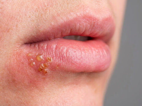 Close up of human lips with cold sores and blisters herpes