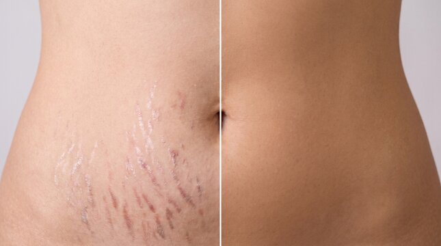 Stretch Mark Removal Striae Reduction Before After Reduction Stretchmarks Abdomen Skin Treatment Result Comparison	