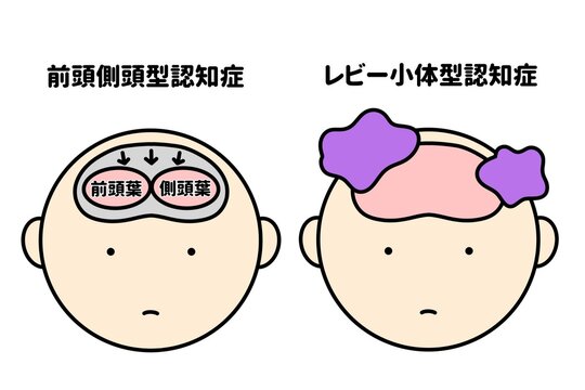 認知症のシンプルなイラスト