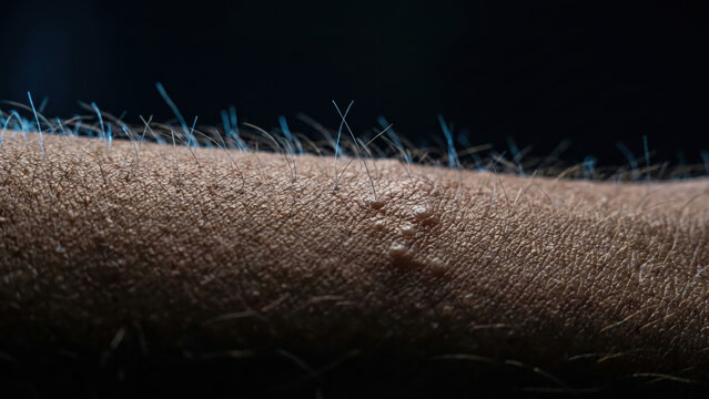 Close-up macro shot of human skin with goosebumps and visible skin growths.