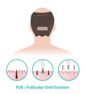 FUE hair transplant procedure icon set with bald man illustration. Extract hair grafts one by one from the donor area and transplanted into the target area. Hair care concept. 