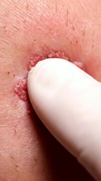 Close-Up Examination of Squamous Cell Carcinoma on Human Skin by Medical Professional