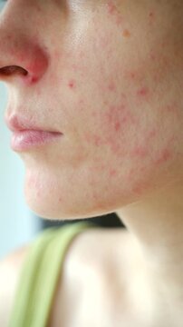 Close up young woman face with red allergic rash, displaying symptoms of atopic dermatitis, rosacea, or skin irritation caused sensitivity to food or cosmetics. Woman showing facial skin allergy rash