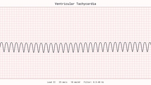 Ventricular Tachycardia VTach Rapid Heartbeat Arrhythmia Emergency ECG EKG Monitor 4K Video Code Blue Cardiology Clinic Vital Signs Patient Tracing Healthcare Critical Care Heart Disease Display