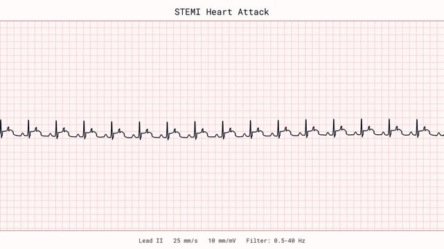 STEMI Heart Attack Myocardial Infarction ST Elevation Ischemia Cardiac Arrest Emergency ECG EKG Monitor 4K Video Cardiology Clinic Vital Signs Patient Tracing Healthcare Critical Care Animation