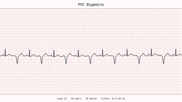 PVC Bigeminy Premature Ventricular Contractions Arrhythmia Skipped Beat Palpitation ECG EKG Monitor 4K Video Cardiology Clinic Vital Signs Patient Tracing Healthcare Heart Disease Rhythm Display
