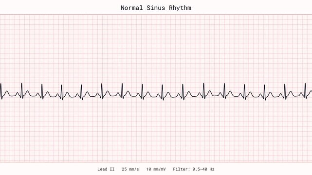 Normal Sinus Rhythm ECG EKG Heartbeat Monitor Medical 4K Video Cardiology Clinic Vital Signs Patient Tracing Seamless Loop Healthcare Diagnostic Beating Healthy Heart Rate Pulse Animation Display