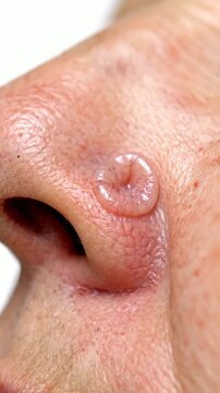 Close-Up Of Basal Cell Carcinoma Lesion On Human Nose Capturing Detailed Textures In A Medical Context