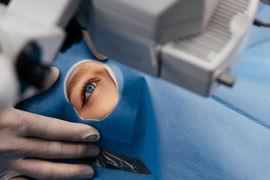 Patient's eye isolated with a sterile surgical drape during ophthalmic surgery under an operating microscope. Modern cataract treatment, precision eye care, advanced medical technology 