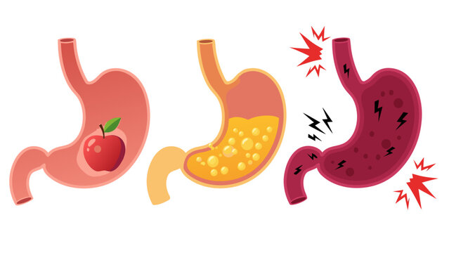 The stomach digests food normally then becomes inflamed and painful with 403.eps