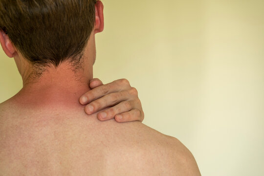 Close-up of a man with red sunburn skin on his neck 
