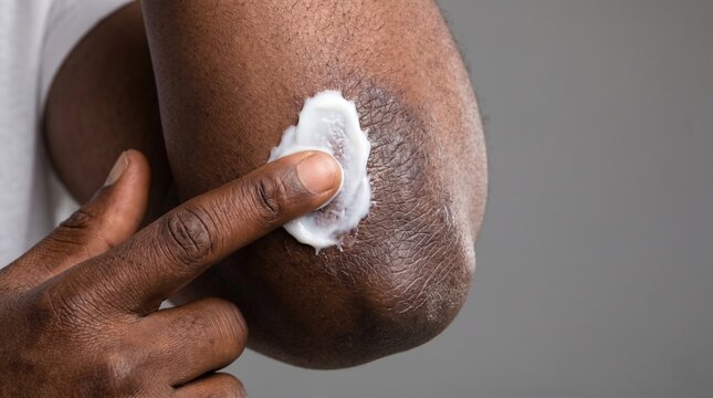 Close up of African American man applying medicinal white cream onto dark elbow skin