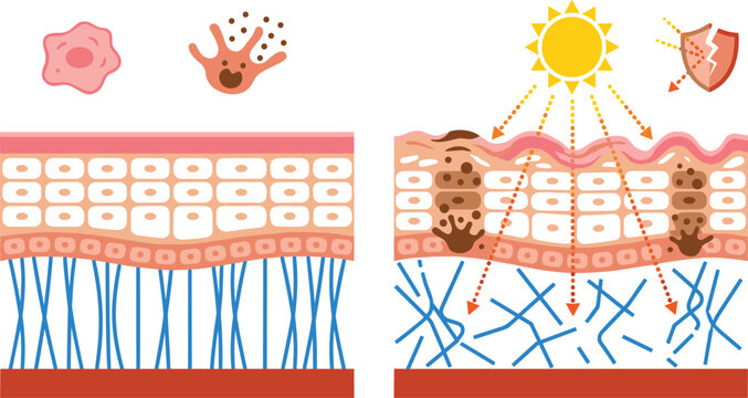 Skin damage and UV exposure infographic illustrating healthy skin, pigmentation, collagen degradation, sun damage, and dermatology protection concepts