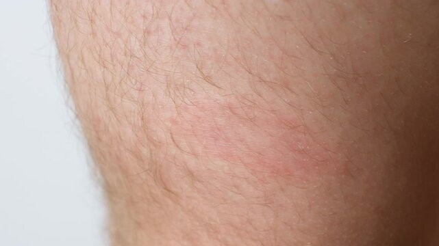 Close-up of erythema migrans rash caused by Lyme disease on patient skin.