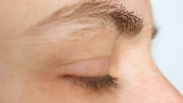 Advanced keratoconus eye disease macro profile view