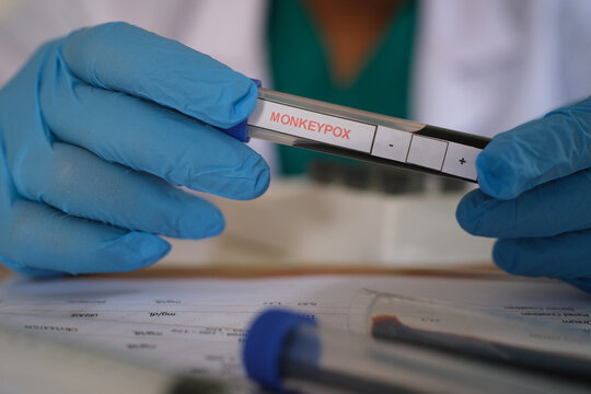 Monkeypox test tube in doctors hand, medical worker holding blood sample for smallpox virus diagnosis and monkey pox research. Concept of monkeypox outbreak, testing, health and treatment.
