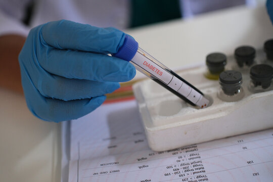 Hand holding a blood sample with the word DIABETES written on it. A blood test to analyze the possibility of high blood sugar levels.
