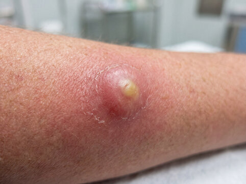 Skin abscess photo of inflamed boil with yellow pus on patient arm for dermatology medical diagnosis usage.