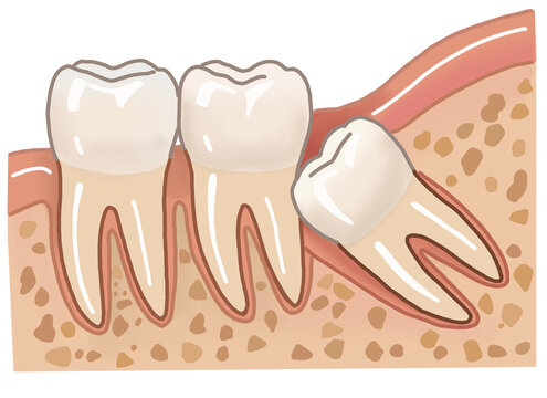 Impacted Wisdom Tooth
