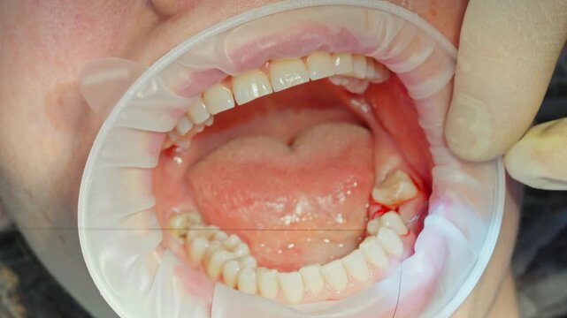 Close up a qualified dental surgeon stitches the gum with sterile threads after installing a dental implant bode, which is screwed into the bone jaw