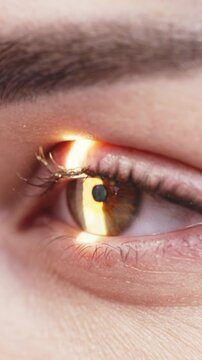 Close-up of a human eye during a diagnostic slit lamp examination, showcasing the illuminated cornea and pupil with detailed iris structure in a clinical setting