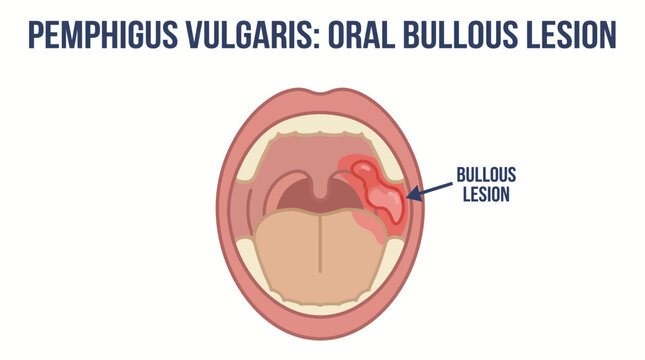Pemphigus Vulgaris Oral Bullous Lesion Illustration