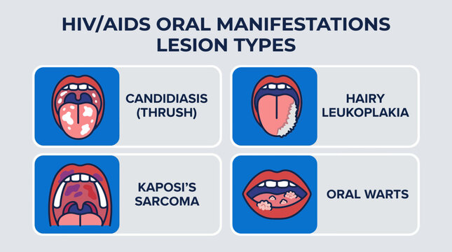 HIV AIDS Oral Manifestations Lesion Types