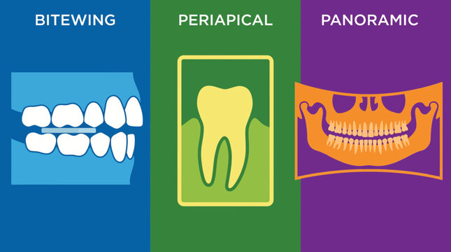 Dental Radiograph Types Bitewing Periapical Panoramic