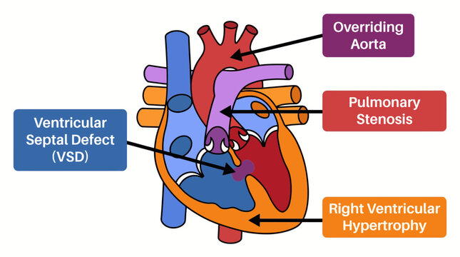 Tetralogy of Fallot Four Defect Congenital Heart Disease Diagram
