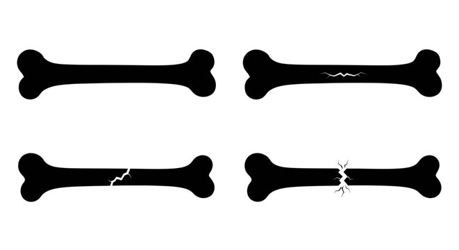 Human bone silhouettes including normal and fractured types